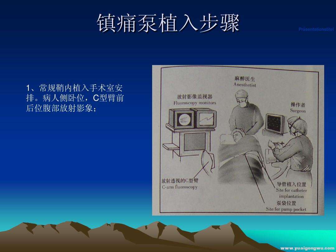 止痛泵的初步认识图文